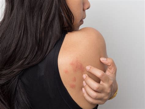 If someone is rash or does rash things, they act without thinking carefully first, and. What Does Stress Rash Look Like? | Balmonds