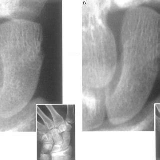 Results of the diagnostic algorithm in suspected scaphoid ...