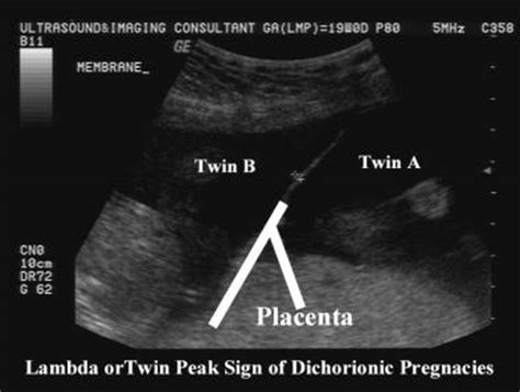 The ancient grammarians and dramatists give evidence to the pronunciation as (λάβδα) in classical greek times. Nagendra's Radiology Blog: RADIOLOCY MCQ--Sunburst sign ...