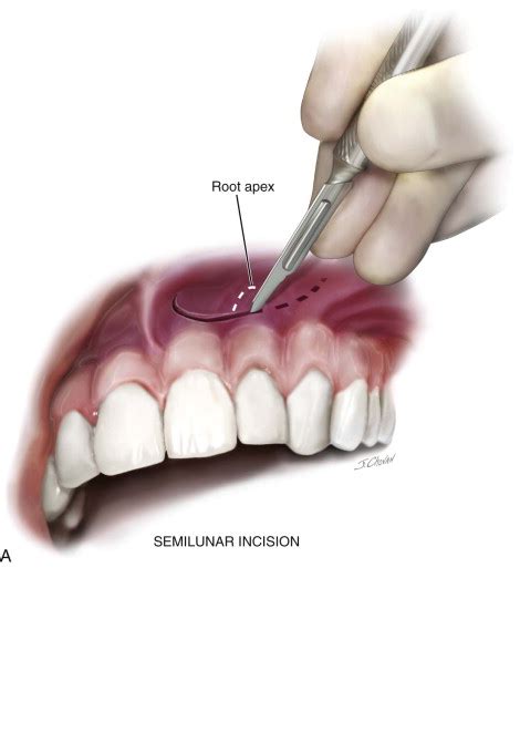 Apicoectomy Pocket Dentistry