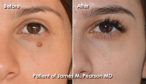 Photos Mole Removal Dr James Pearson Facial Plastic Surgery