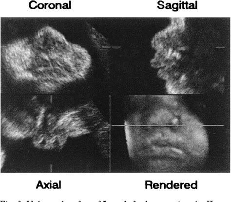 Figure 2 From Three Dimensional Ultrasound Imaging Semantic Scholar