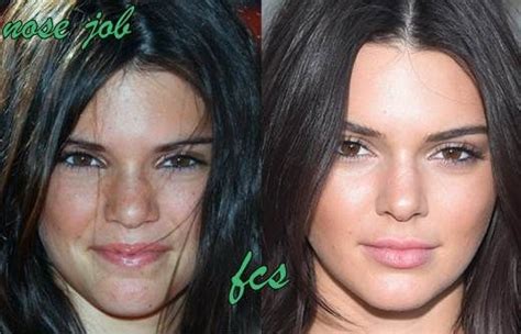 Kendall Jenner Plastic Surgery Before And After Photos Kendall Jenner
