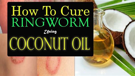How To Cure Ringworm Using Coconut Oil Youtube