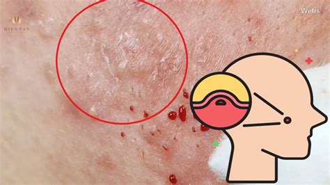How To Removal Cystic Acne Blackheads And Whiteheads Acne Treatment