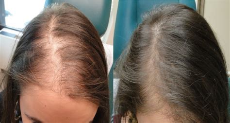 Chute De Cheveux Causes Traitement Efficace
