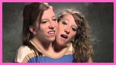 Top 10 Interesting Stories Of Conjoined Twins Youtube