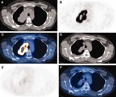 Positron Emission Tomography Imaging In Nonsmall‐cell Lung Cancer