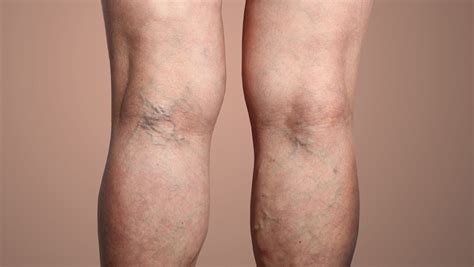 Are Varicose Veins Dangerous What Are The Symptoms And Treatments
