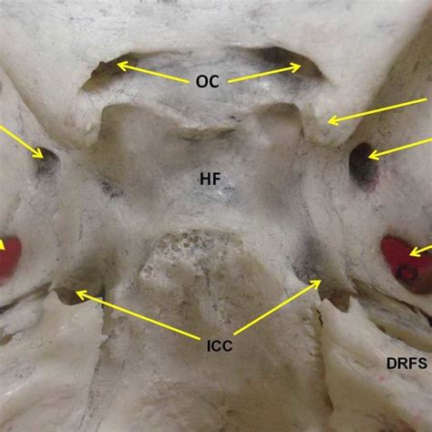 Photograph Of The Base Of The Skull Showing Confluent Foramen Ovale And