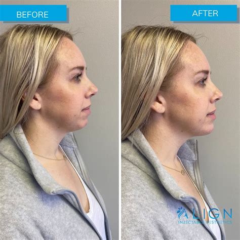 Before And After Chin Filler Align Injectable Aesthetics