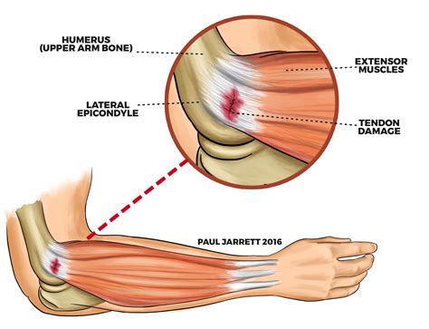 Aardrijkskunde Sneeuwman Brandewijn Tennis Elbow Lateral Epicondylitis