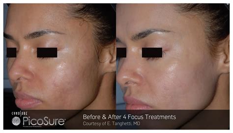 Treatment Picosure Skin Med Laser