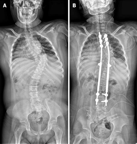 Respiratory Failure After Scoliosis Correction Surgery In Patients With