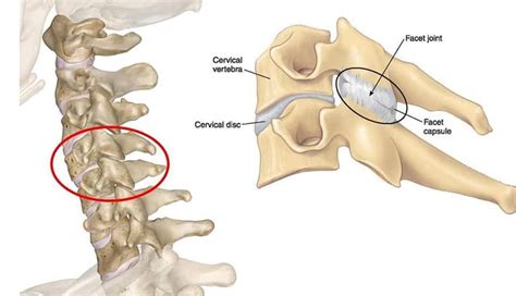 Cervical Facet Joint Pain Complete Physio