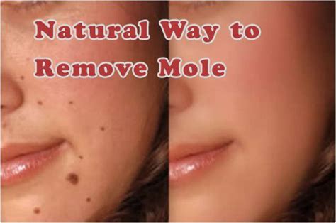 Beauty And Fitness How To Get Rid Of Moles On Face Extremely Fast
