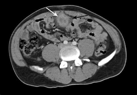 Axial Ct Image Showing Abscess Formation In Patent Urachus Posterior To