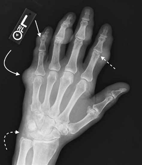 E Single Anteroposterior Radiograph Of The Hand Shows Multiple