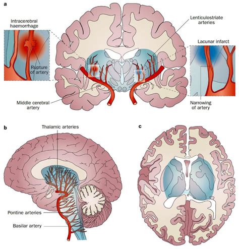 The Vascular Centrencephalon Pathophysiology Of Lacunar Infarction And Download Scientific