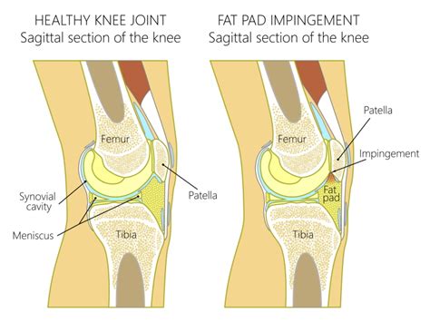 Fat Pad Impingement What Are Your Options