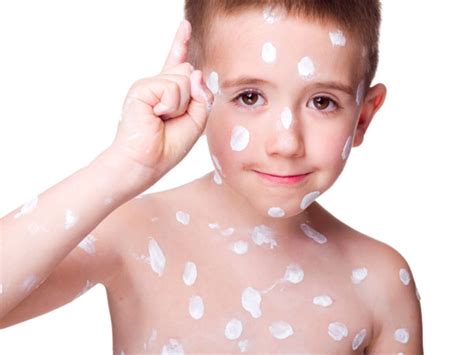 How To Treat Chickenpox Scars Healthy Living