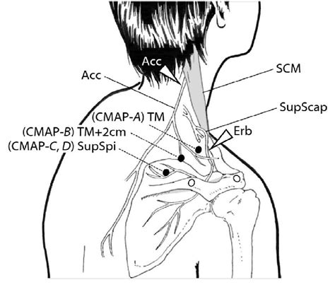 Technique For Ncs Recording Of Cmaps Of The Upper Tm And Supraspinatus