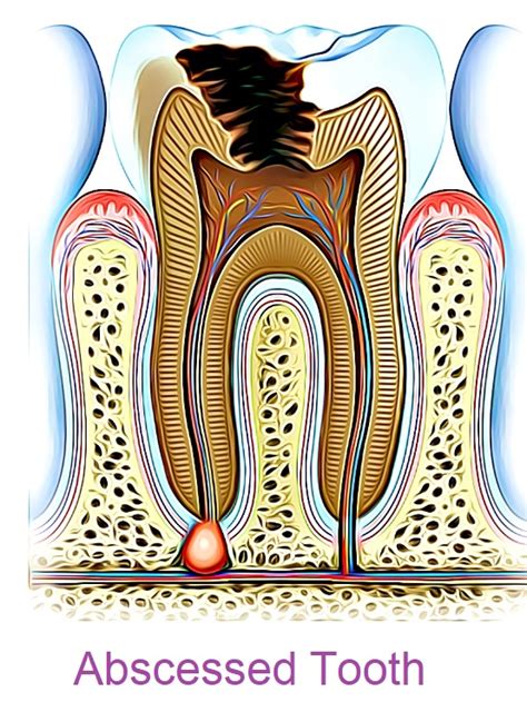 Toothache Causes And Pain Relief Treatments Archer Dental