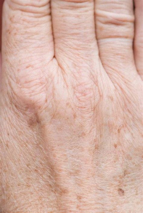 Skin Spots That Appear With Age Dont Have To Be A Permanent Fixture