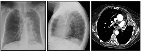 Figure 2 From Revisión De Los Signos Radiológicos De Atelectasia