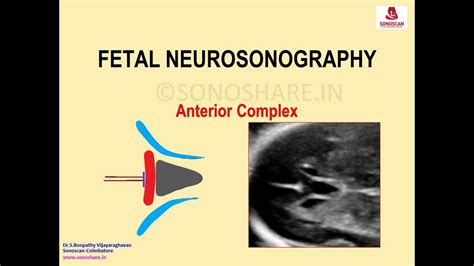 Fetal Neurosonography Anterior Complex Youtube