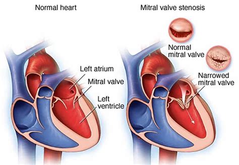 Mitral Stenosis Causes Symptoms Diagnosis Treatment And Prognosis