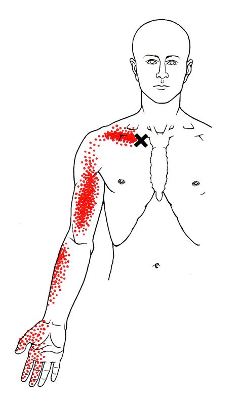 Subclavius The Trigger Point And Referred Pain Guide