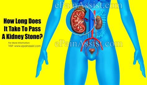 How Long Do Kidney Stones Take To Develop