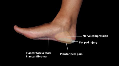 Diagnosis Heel Pain