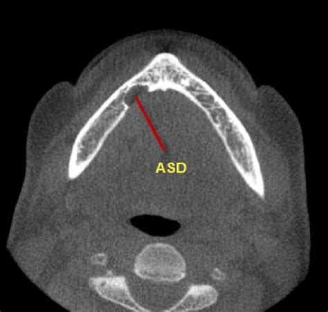 A Stafne Defect Asd Is Seen On This Axial Image On The Right Side Of