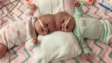 Recently Separated Conjoined Twins Getting Ready To Go Home