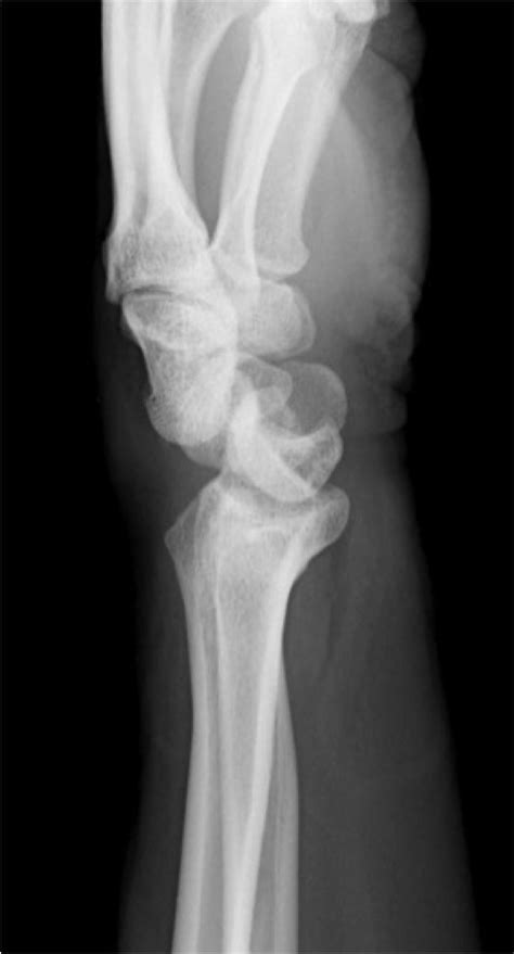 X Ray Wrist Lateral View