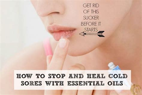 How To Stop And Heal Cold Sores With Essential Oils Healing Cold Sore