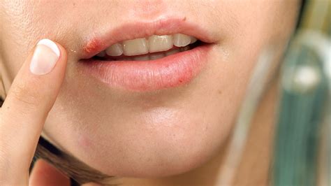 What Is The Cause Of Rashes On Lips