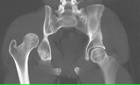 Right Hip Dislocation In 3d Vrt Musculoskeletal Case Studies Ctisus