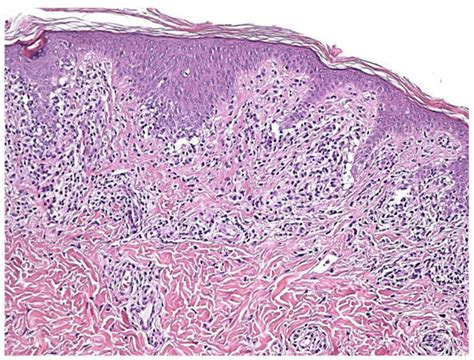 Dermatopathology Free Full Text Annular Lichenoid Dermatitis Of Youth