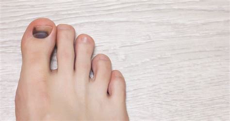 The 4 Most Common Causes Of Black Toenails Foot Healthcare Associates