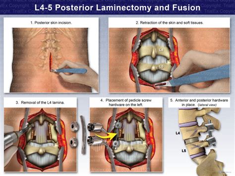 L Posterior Laminectomy And Fusion Trial Exhibits Inc