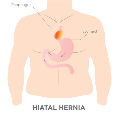 Heartburn Could Be A Hiatal Hernia University Health News