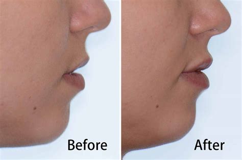 Juvederm® Lips Fillers Facial Cosmetic Surgery Dr Antipov