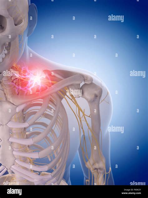 Medically Accurate Illustration Of Painful Cervical Nerves Stock Photo