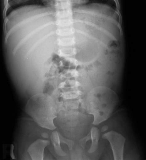 Enlarged Spleen X Ray