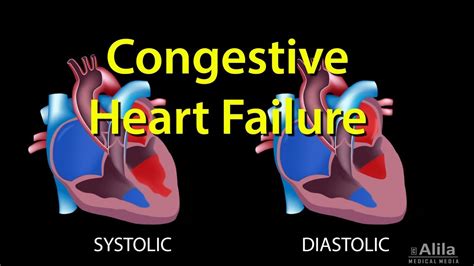 What Is Heart Failure Simple Definition