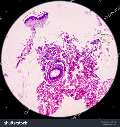 Chest Wall Cystbiopsy Epidermal Inclusion Cyst Stock Photo 2103609452