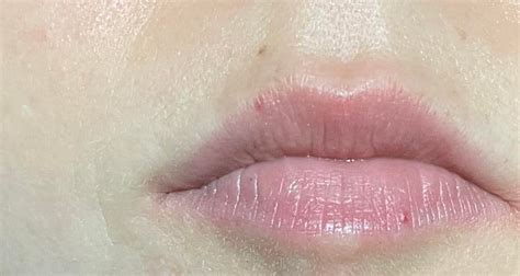 What Are These Spots On My Lips Help Rdermatologyquestions